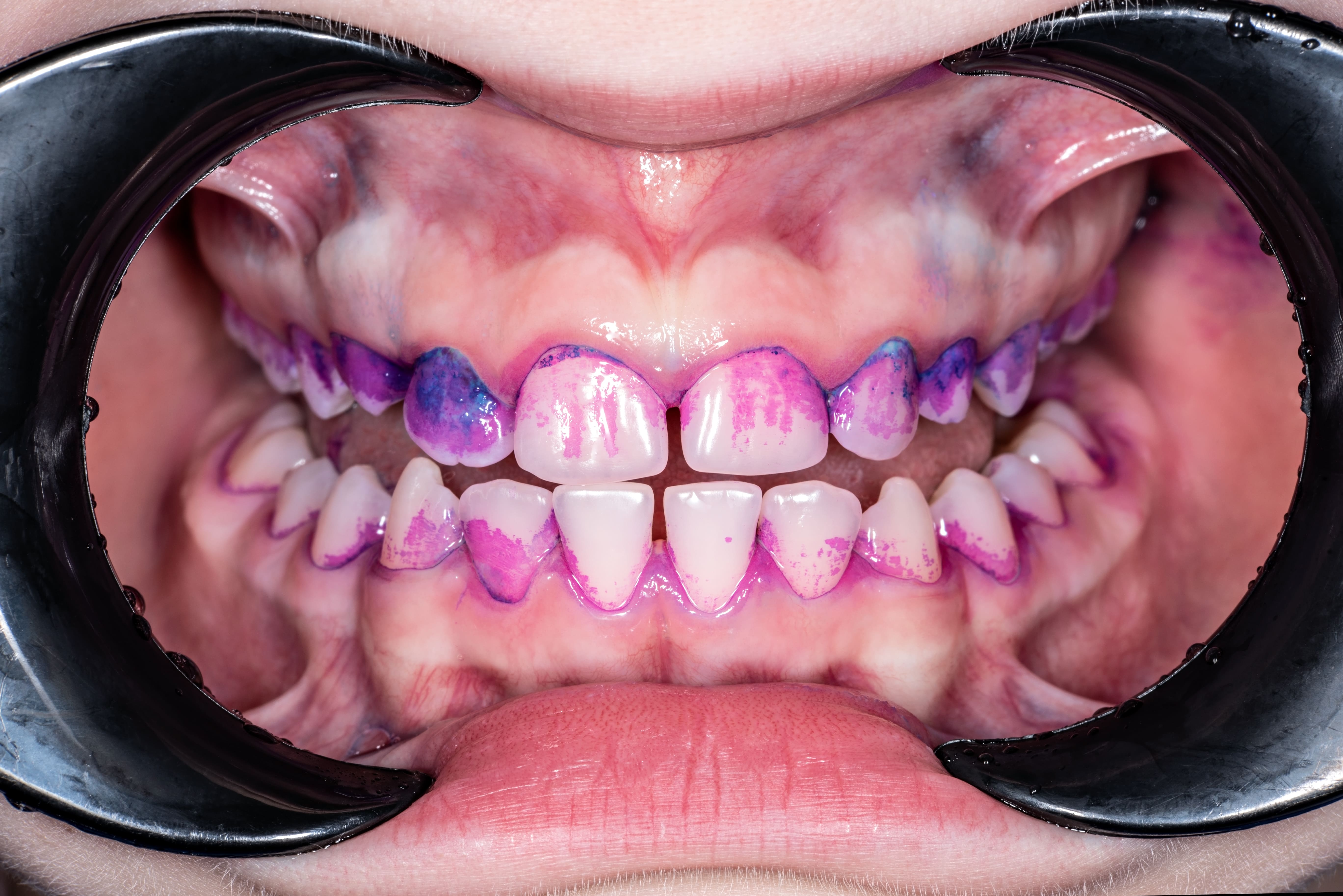 【歯に付着するプラーク（歯垢）について】～天然歯と詰め物との付き方の比較～