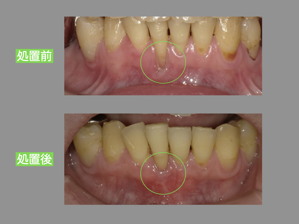 ハグキが下がってしまったら！　歯周外科（根面被覆）症例