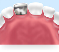 銀歯は金属アレルギーを引き起こす可能性があります