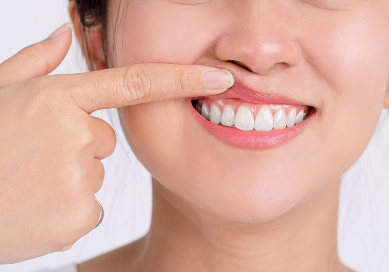 歯ぐきが変色しない