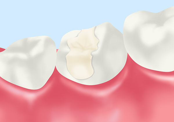 ハイブリッドセラミック（インレー）