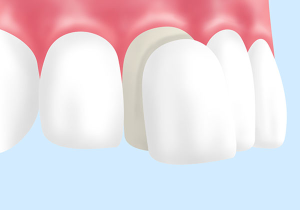 ラミネートべニア