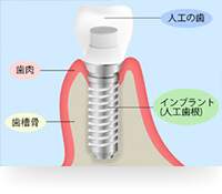 インプラントとは？