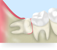 親知らずはトラブルが多い歯です