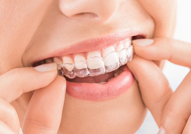 マウスピース矯正：インビザラインGO（iGO）（薬機法対象外）