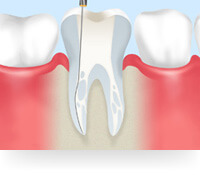 土台を築く根管治療