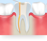 重度の虫歯も治せます（根管治療について）