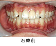 矯正治療により噛み合わせを変える 画像1